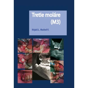 Tretie moláre (M3) - Vladimír Machoň, Dušan Hirjak